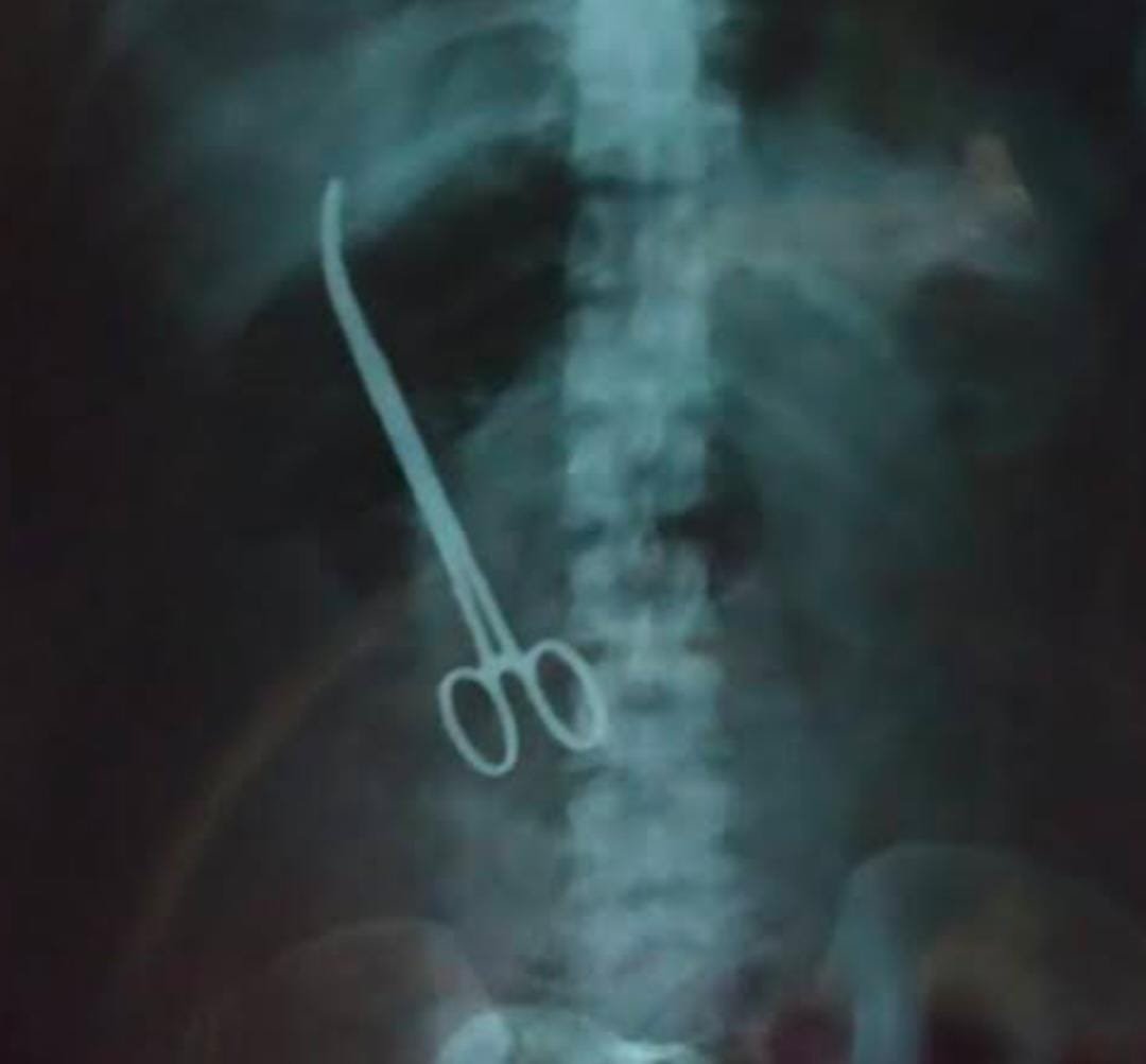 : Woman with Scissors in Stomach After Surgery